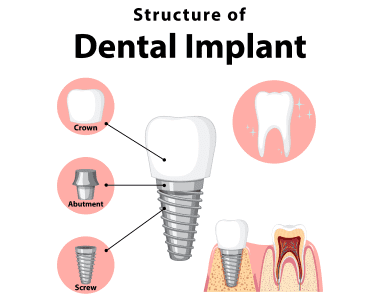 Dental Implants Asheville, NC