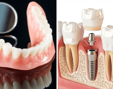 advantages-of-dental-implants-over-dentures